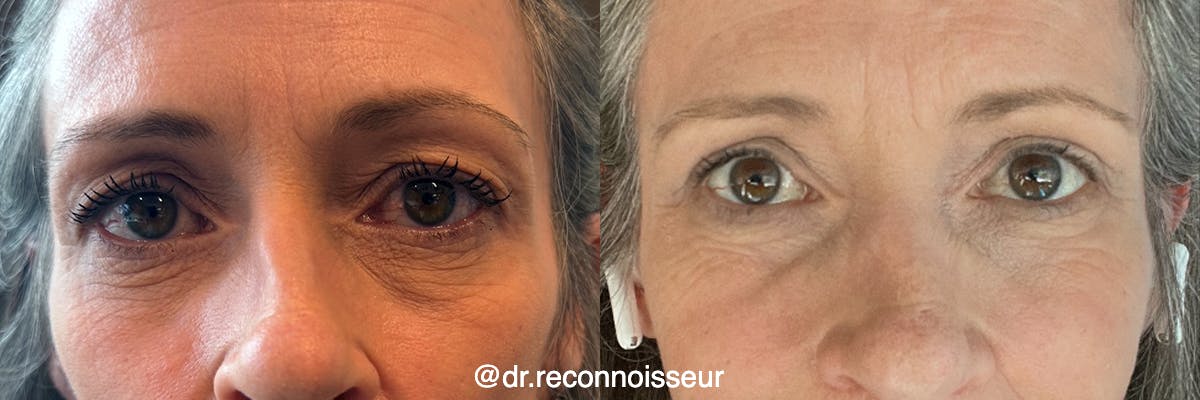 Blepharoplasty (Eyelid Surgery) Before & After Gallery - Patient 222982 - Image 1