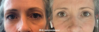 Blepharoplasty (Eyelid Surgery) Before & After Gallery - Patient 222982 - Image 1