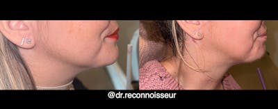Neck Lift - Neck Vaser Lipo Before & After Gallery - Patient 133945 - Image 1
