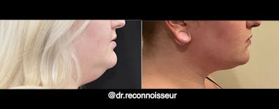 Neck Lift - Neck Vaser Lipo Before & After Gallery - Patient 931237 - Image 1