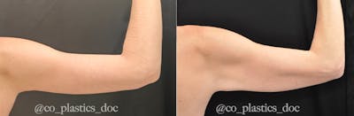 Brachioplasty Before & After Gallery - Patient 770606 - Image 1