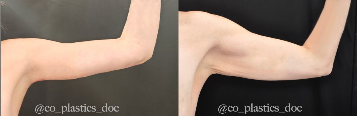 Brachioplasty Before & After Gallery - Patient 770606 - Image 2