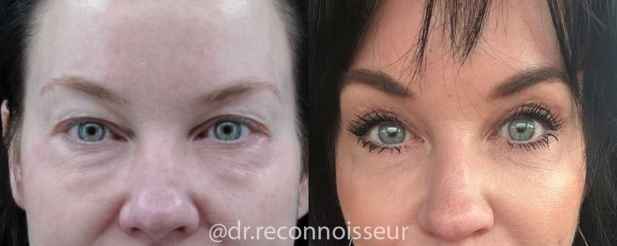 Blepharoplasty (Eyelid Surgery) Before & After Gallery - Patient 179763 - Image 1
