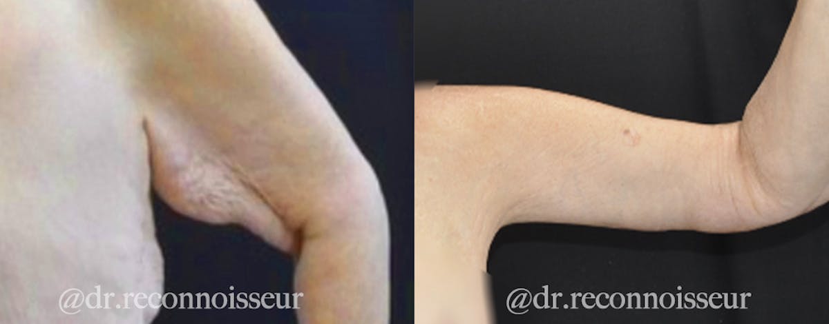 Brachioplasty Before & After Gallery - Patient 568318 - Image 1