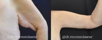 Brachioplasty Before & After Gallery - Patient 568318 - Image 1