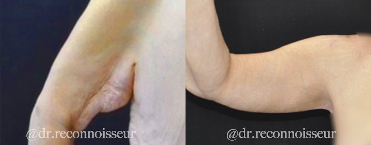 Brachioplasty Before & After Gallery - Patient 568318 - Image 4