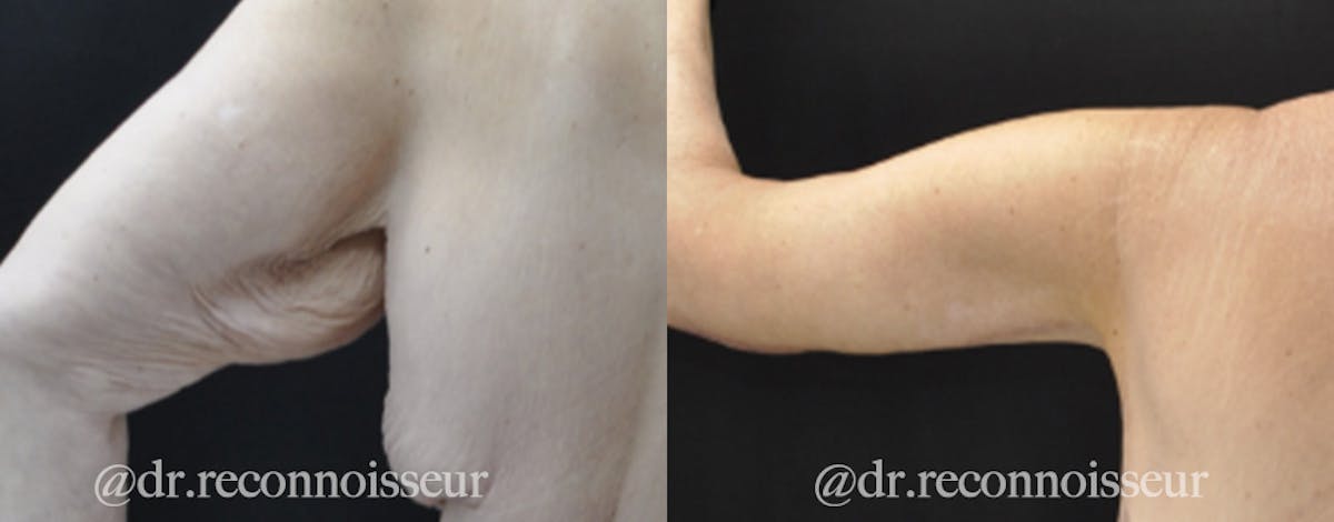 Brachioplasty Before & After Gallery - Patient 568318 - Image 3