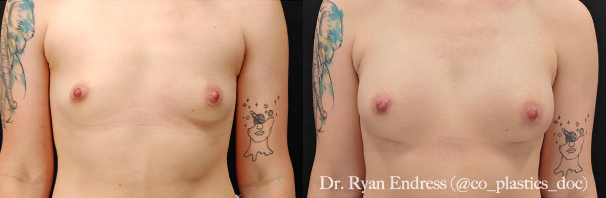 Breast Augmentation Before & After Gallery - Patient 201671 - Image 1