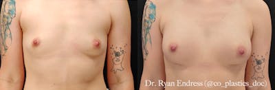 Breast Augmentation Before & After Gallery - Patient 201671 - Image 1