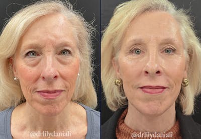 Facelift Before & After Gallery - Patient 248134 - Image 1
