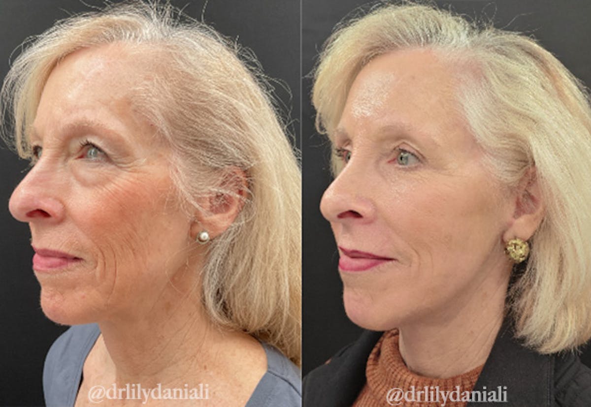 Facelift Before & After Gallery - Patient 248134 - Image 2