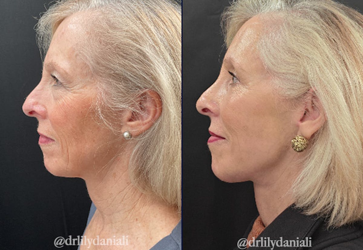 Facelift Before & After Gallery - Patient 248134 - Image 3