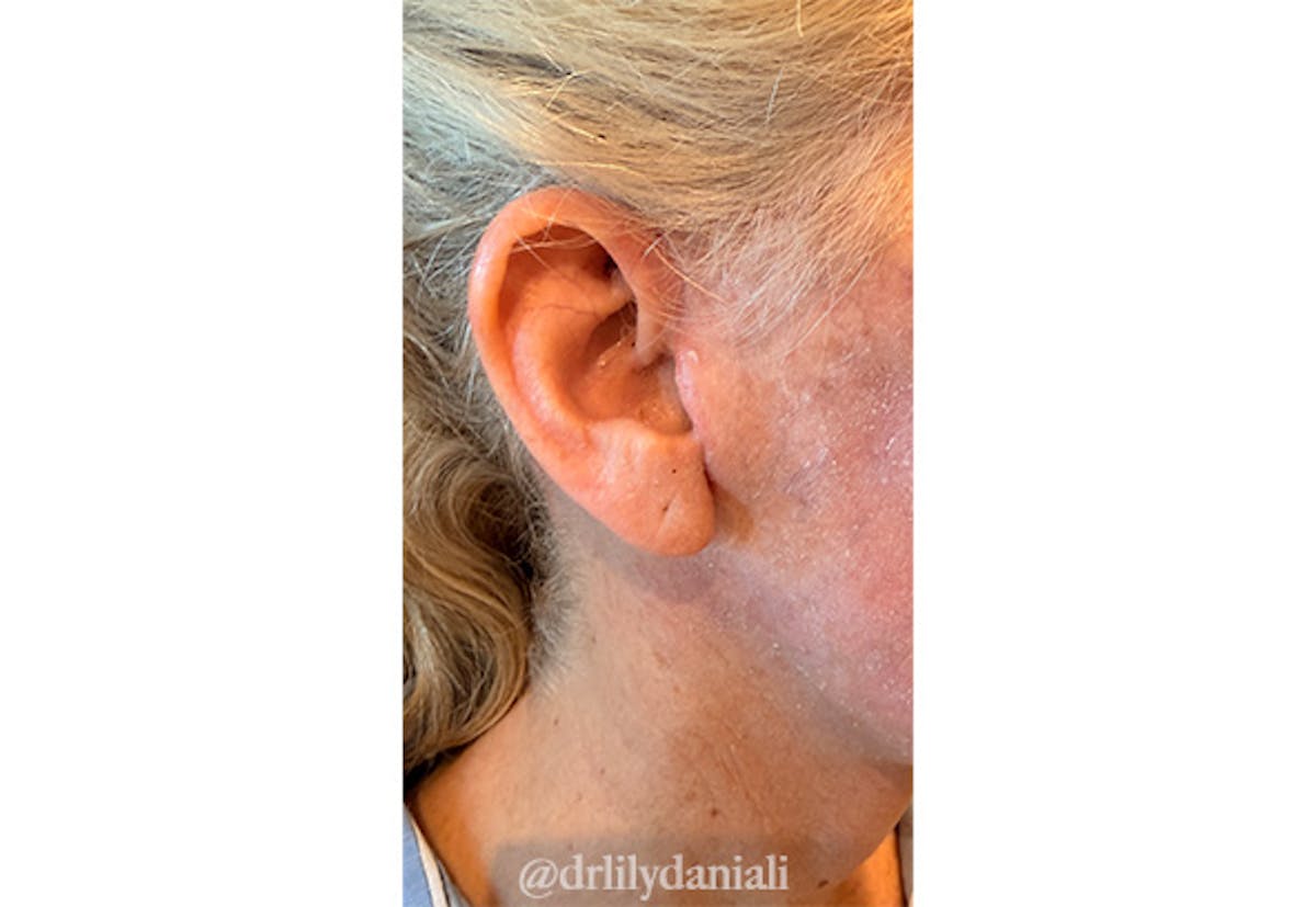 Facelift Before & After Gallery - Patient 248134 - Image 4