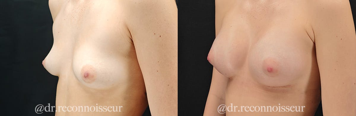 Breast Augmentation Before & After Gallery - Patient 229614 - Image 2