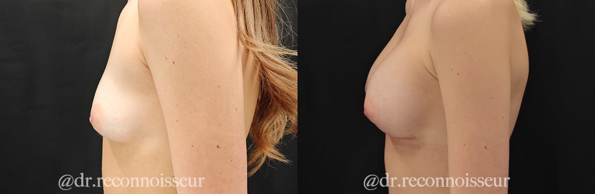 Breast Augmentation Before & After Gallery - Patient 229614 - Image 3