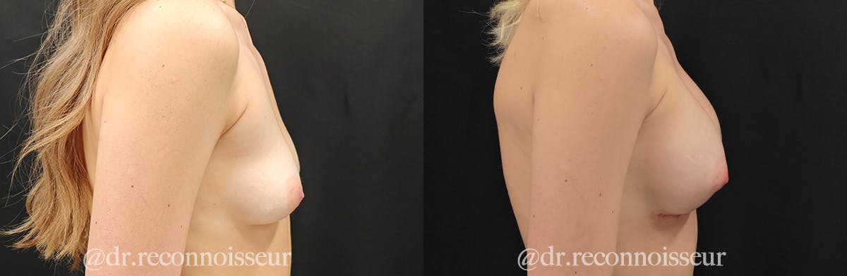 Breast Augmentation Before & After Gallery - Patient 229614 - Image 4