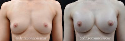 Breast Augmentation Before & After Gallery - Patient 208751 - Image 1