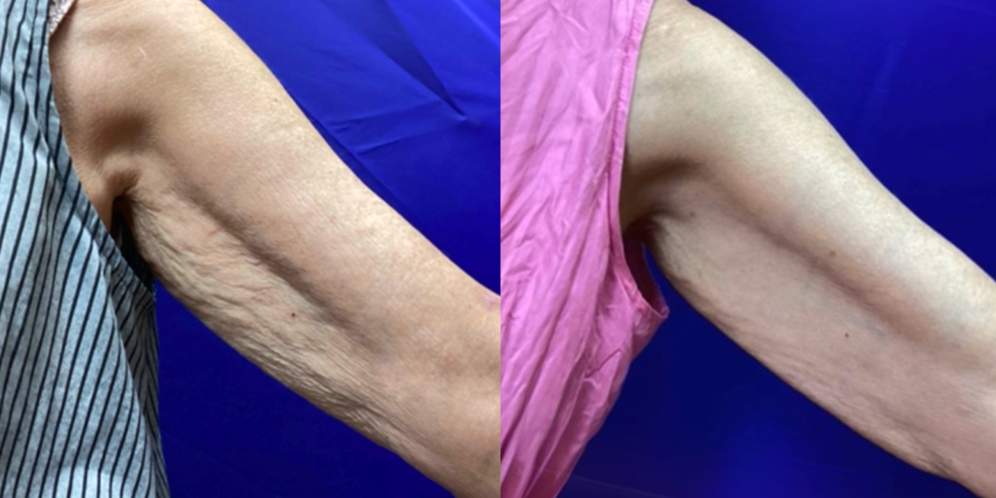 before and after image of sofwave on left arm