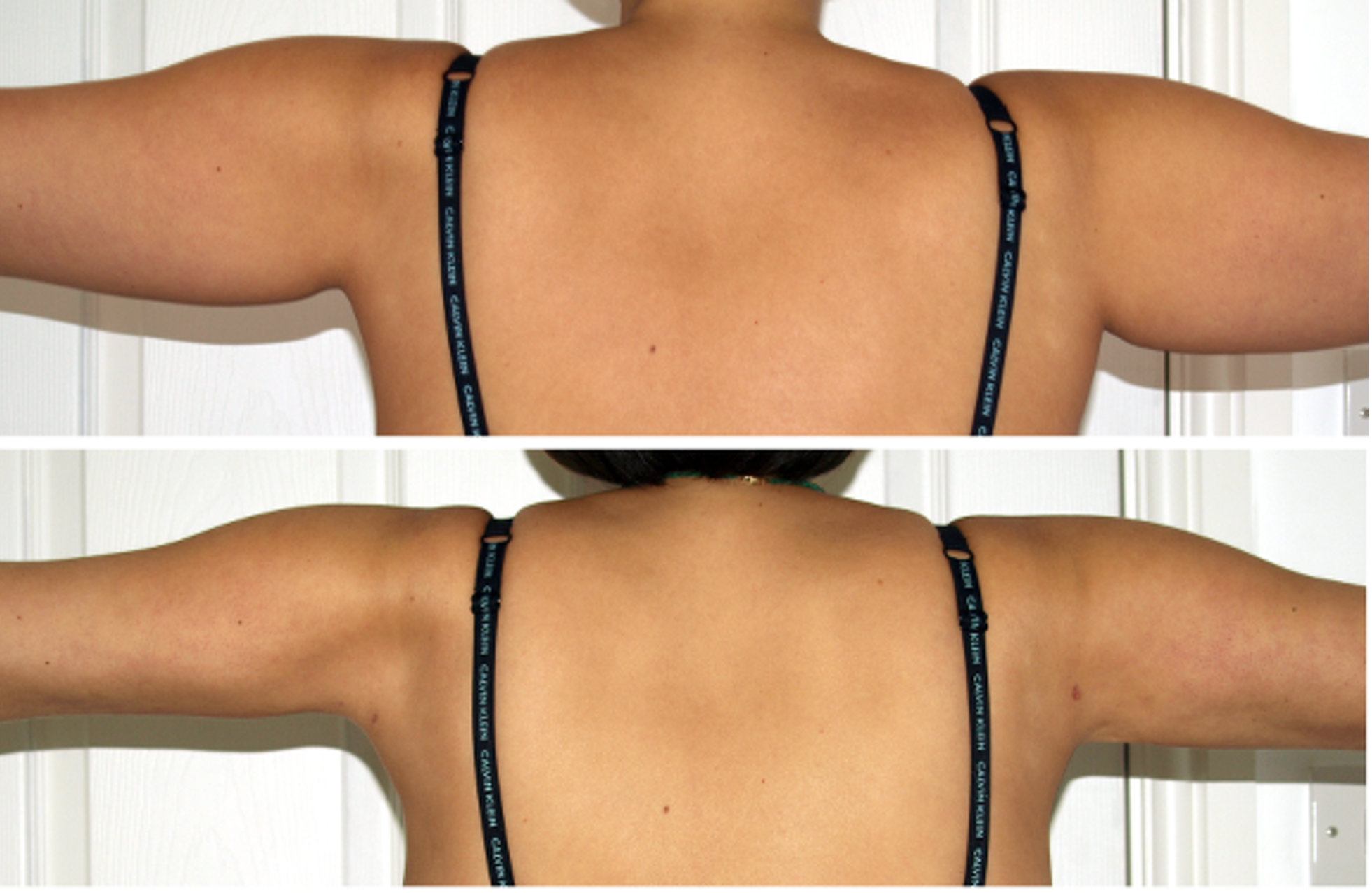 before and after image of someones back treated by VASER