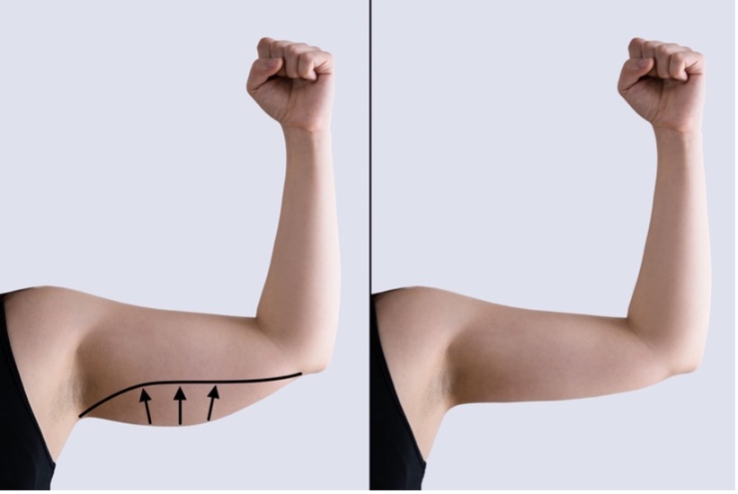 before and after image of a brachioplasty