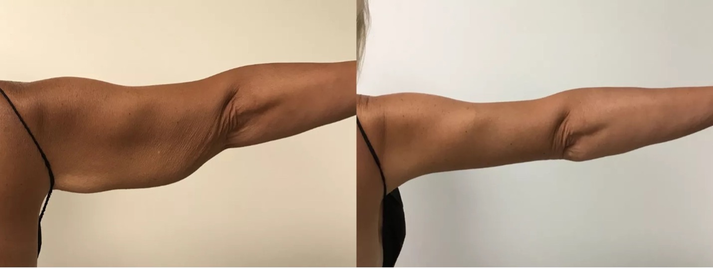 before and after of an arm lift