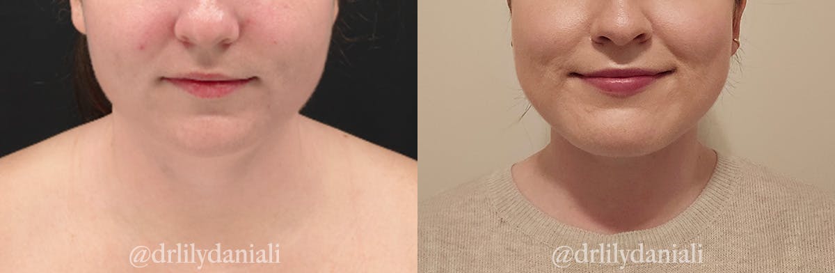 Neck Lift - Neck Vaser Lipo Before & After Gallery - Patient 396741 - Image 3
