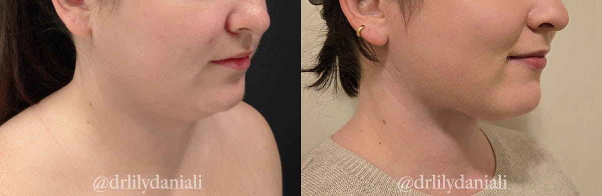Neck Lift - Neck Vaser Lipo Before & After Gallery - Patient 396741 - Image 2