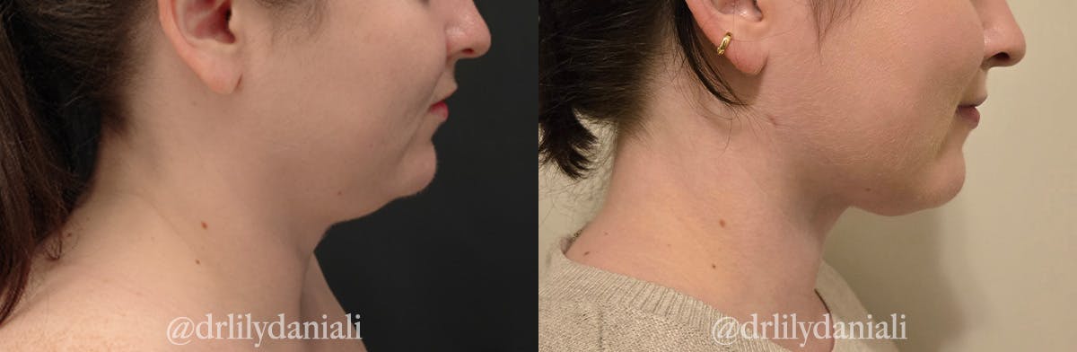 Neck Lift - Neck Vaser Lipo Before & After Gallery - Patient 396741 - Image 1