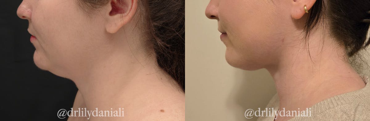 Neck Lift - Neck Vaser Lipo Before & After Gallery - Patient 396741 - Image 5