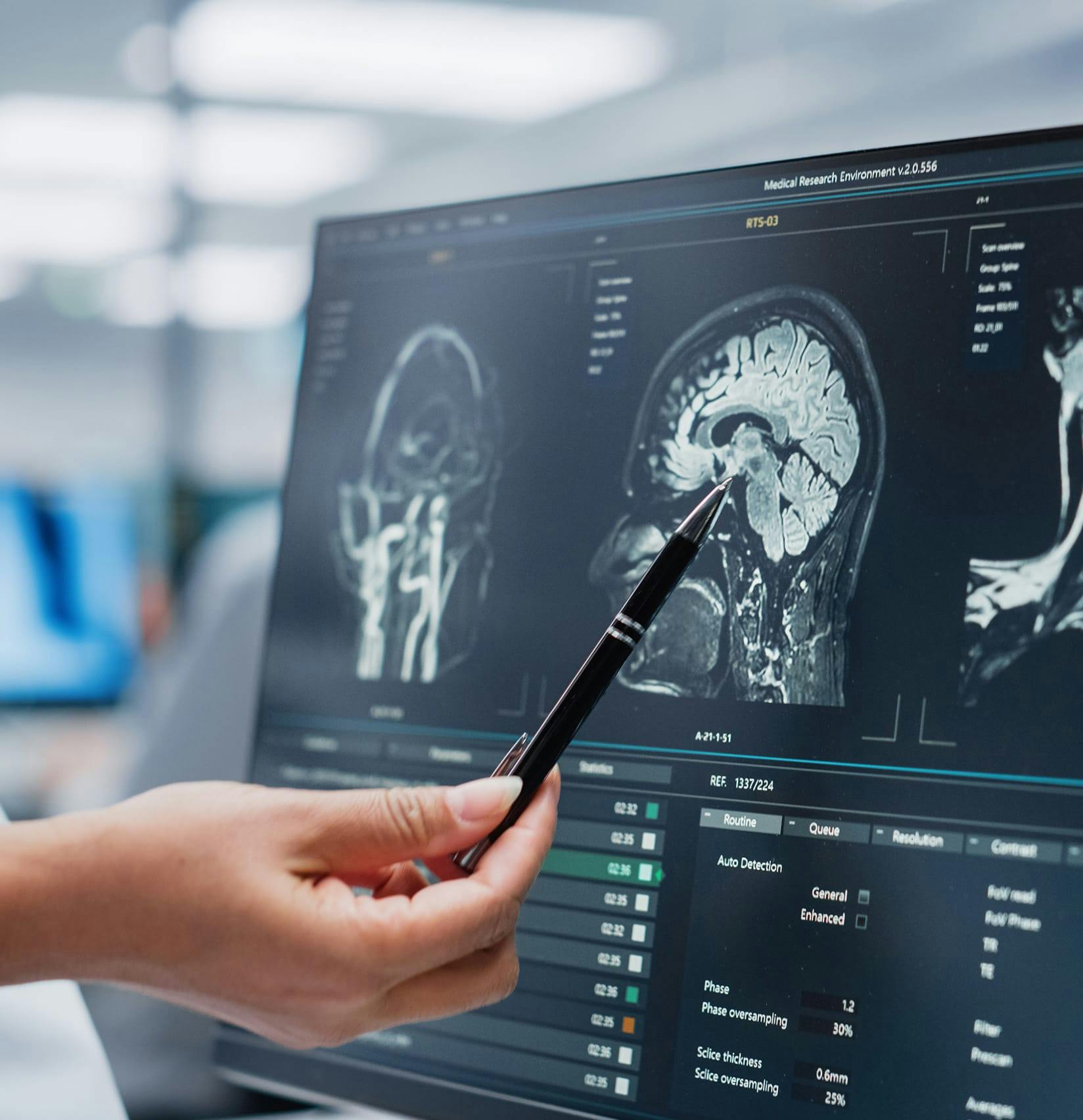 Brain scan with a doctor pointing to it