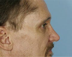 Autologous Fat and Fillers in Periocular Rejuvantion in Austin, Texas Autologous Fat and Fillers in Periocular Rejuvantion in Austin, Texas