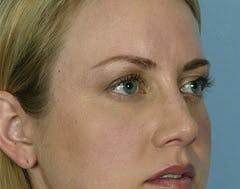 Autologous Fat and Fillers in Periocular Rejuvenation for Austin, Texas patients Autologous Fat and Fillers in Periocular Rejuvenation for Austin, Texas patients