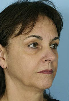 lower eyelid in texas after lower eyelid in texas after