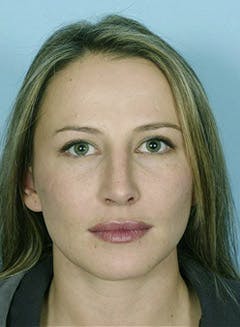 before lower eyelid and cheek in texas before lower eyelid and cheek in texas