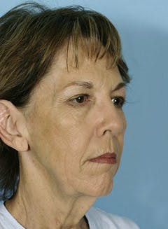 after lower eyelid and cheek in texas after lower eyelid and cheek in texas