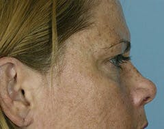 fat transfer patient before in austin fat transfer patient before in austin