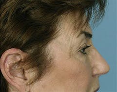 fat transfer patient after in austin fat transfer patient after in austin