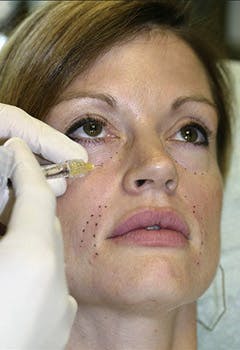 HA injection patient before in texas HA injection patient before in texas