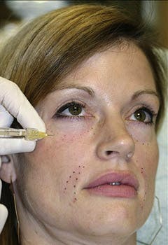 HA injection patient after in texas HA injection patient after in texas