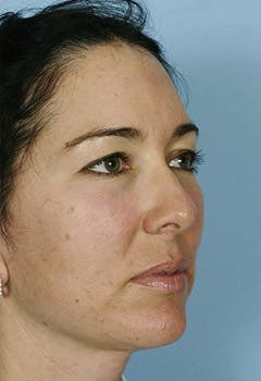 after treatment with HA filler in texas after treatment with HA filler in texas