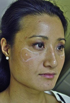 fat and fillers texas fat and fillers texas