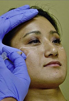 Transcutaneous and transoral depot injection of Radiesse before in texas Transcutaneous and transoral depot injection of Radiesse before in texas