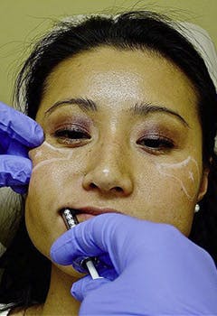 and transoral depot injection of Radiesse after in texas Transcutaneous and transoral depot injection of Radiesse after in texas