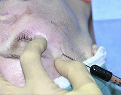 Autologous Fat and Fillers Treatment in Austin Autologous Fat and Fillers Treatment in Austin