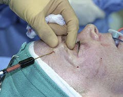 Autologous Fat and Fillers Treatment Austin | Texas Autologous Fat and Fillers Treatment Austin | Texas