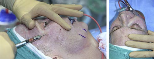 process on lateral cheek, texas process on lateral cheek, texas