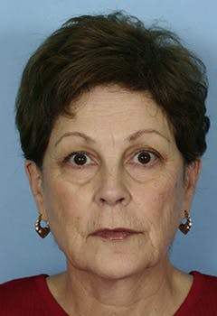 full face fat transfer texas before full face fat transfer texas before