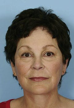 full face fat transfer texas after full face fat transfer texas after