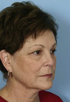 full face chemical peel in texas before full face chemical peel in texas before