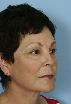 full face chemical peel in texas after full face chemical peel in texas after